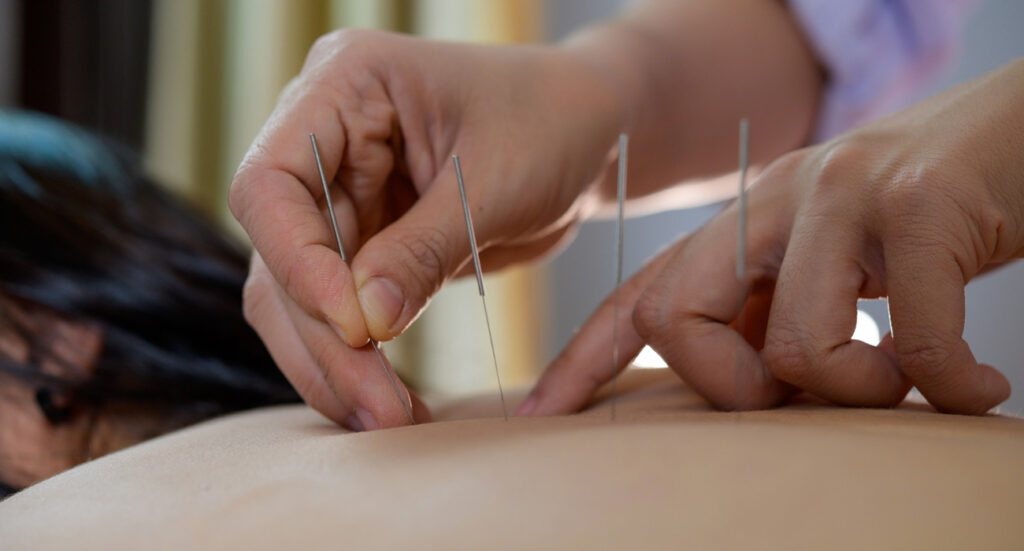 Reviving Male Vitality Through Acupuncture