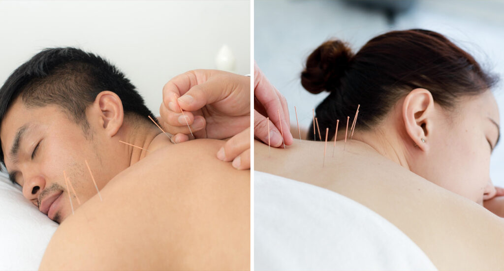 Acupuncture for Fertility: A Natural Aid for Men and Women