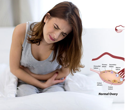 Polycystic Ovary Syndrome (PCOS)